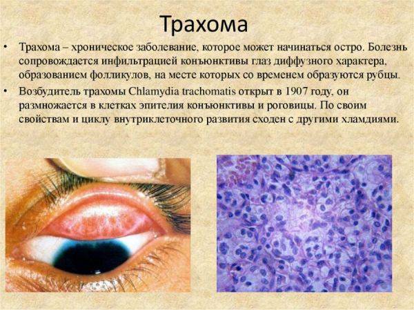 Трахома глаз: фото, симптомы, лечение, возбудитель