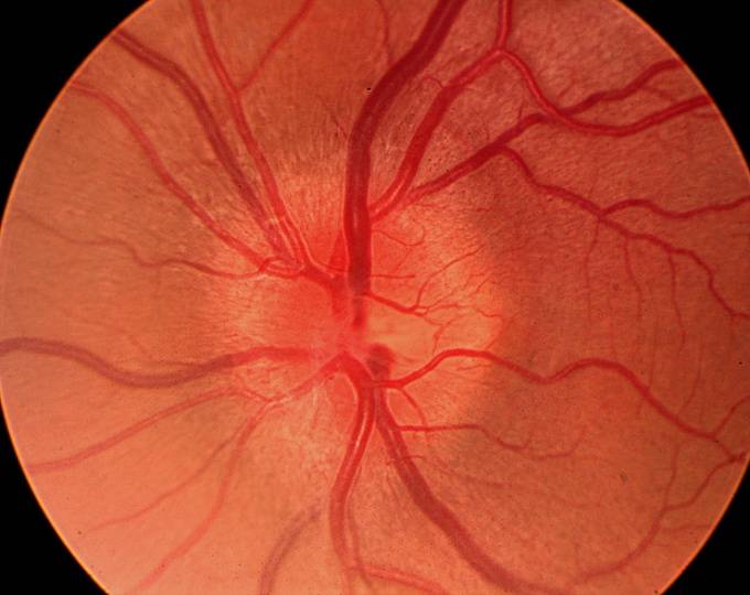 Алкоголизация зрительного нерва при глаукоме - вылечимглаукому