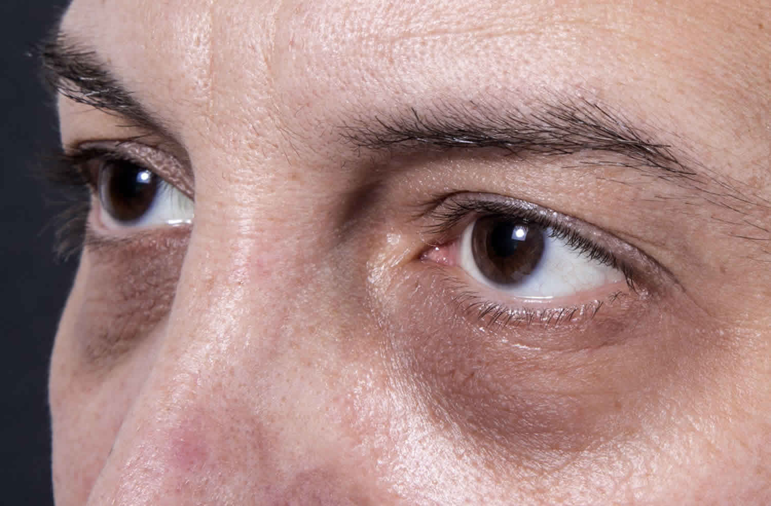 Причины возникновения темных кругов под глазами у мужчин