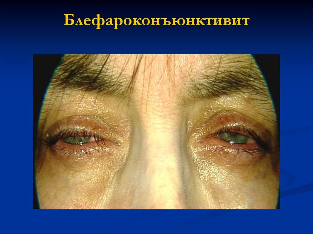 Блефарит: симптомы и лечение у взрослых, причины воспаления, что это такое (фото)