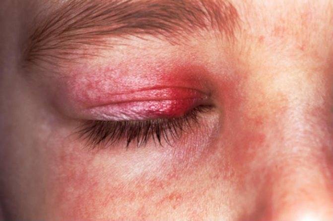 Как избавиться от дерматита вокруг глаз?