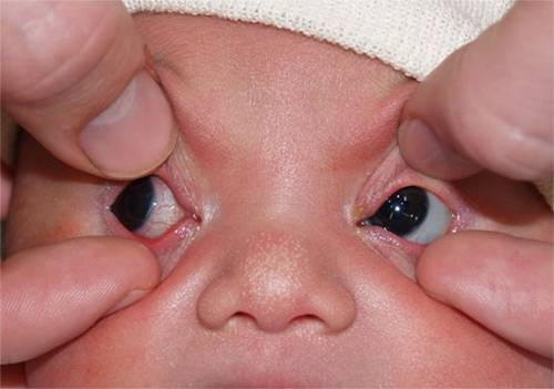 Непроходимость слезного канала у новорожденных: симптомы и лечение закупорки слезных каналов