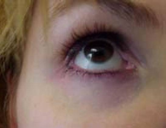Почему возникают синяки под глазами у ребёнка: 10 основных причин