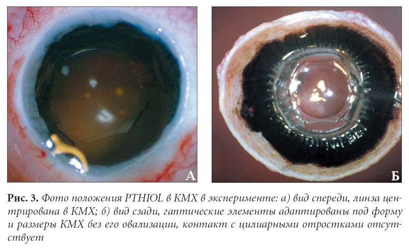 Вторичная катаракта после операции: симптомы и лечение