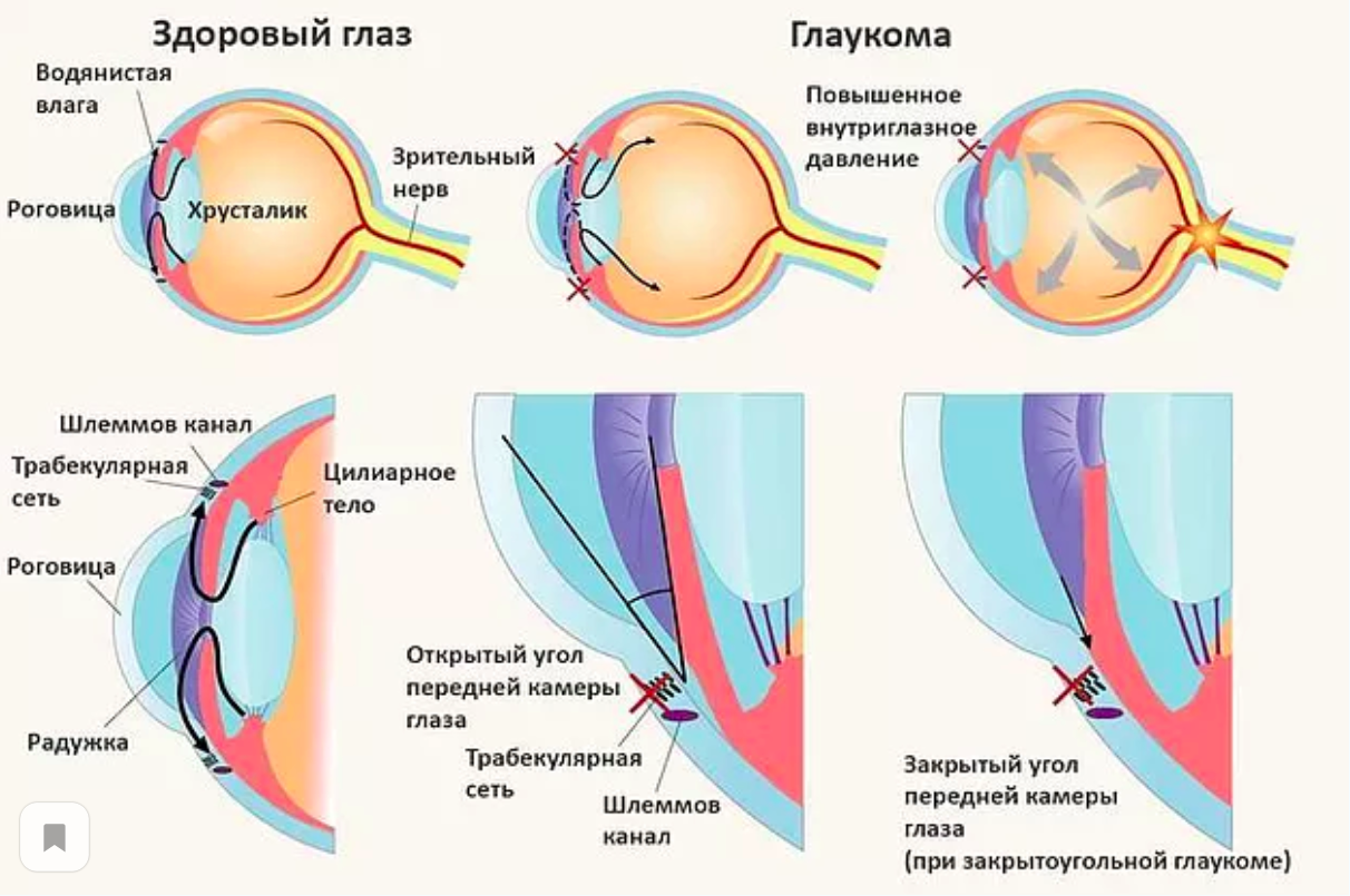 Что такое узкоугольная глаукома и как ее лечить?
