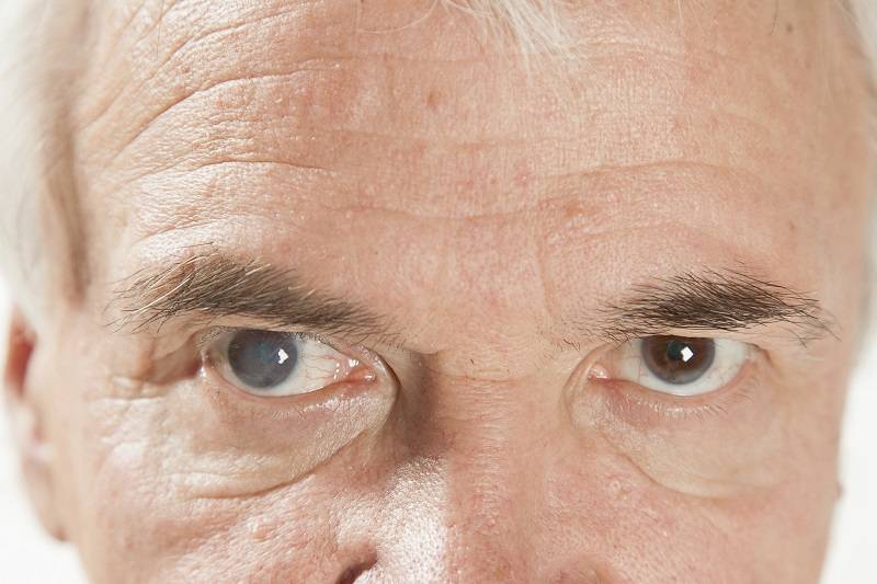 Двоение в глазах: причины возникновения и лечения диплопии