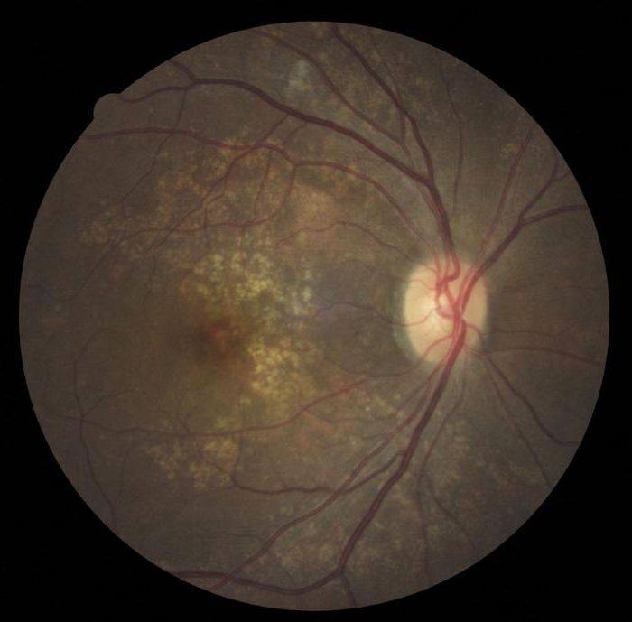 Ангиосклероз сетчатки глаза - что это, причины, симптомы, лечение