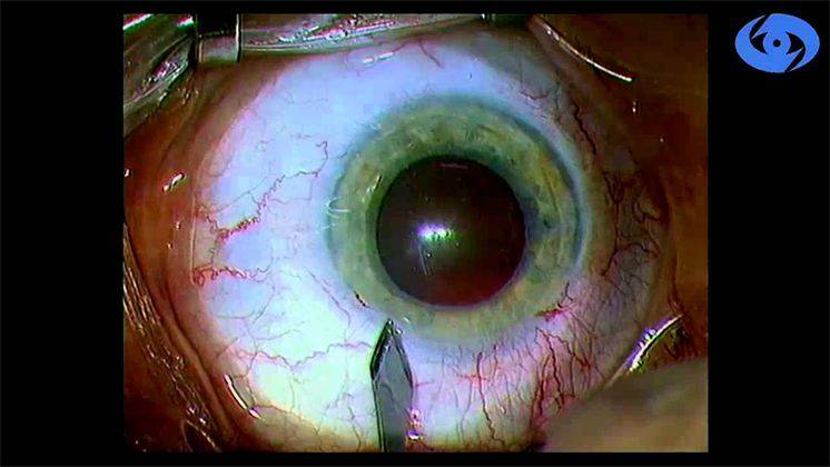 Реабилитация после операции на катаракту глаза