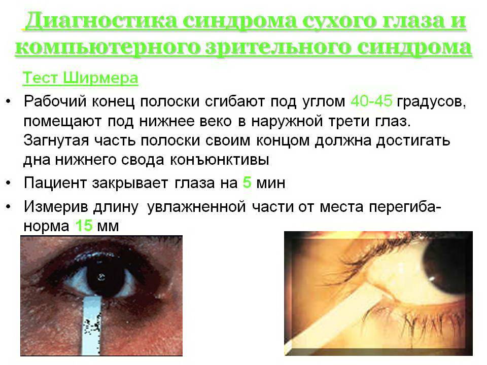 Синдром сухого глаза — симптомы, лечение народными средствами, профилактические меры
