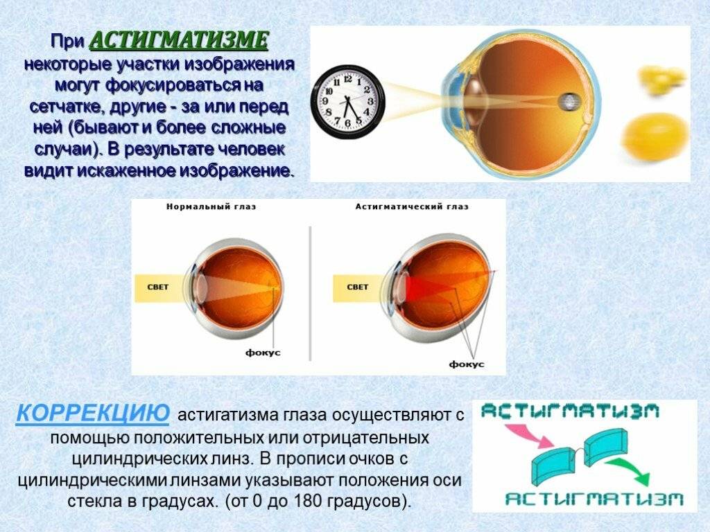 Смешанный астигматизм одного и обоих глаз: что это такое, причины, симптомы, лечение, диагностика, профилактика