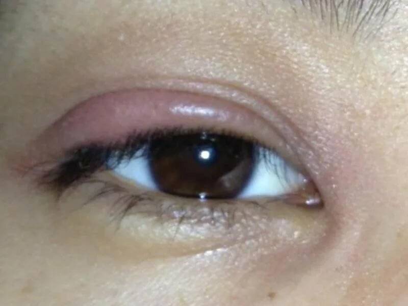 Покраснение глаз - причины и лечение в домашних условиях