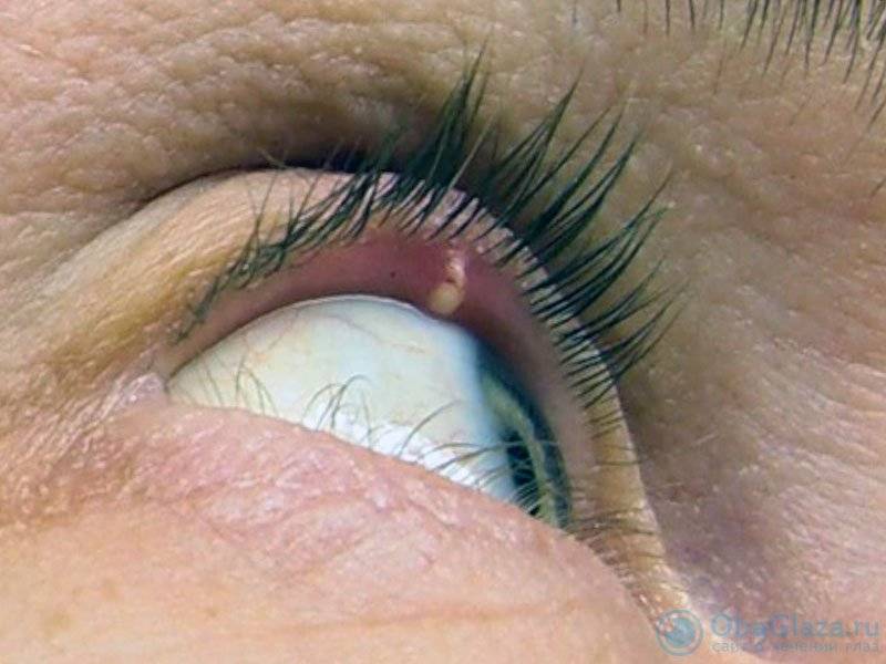Внутренний ячмень на глазу: причины мейбомита верхнего и нижнего век, как лечить острое и хроническое восполение