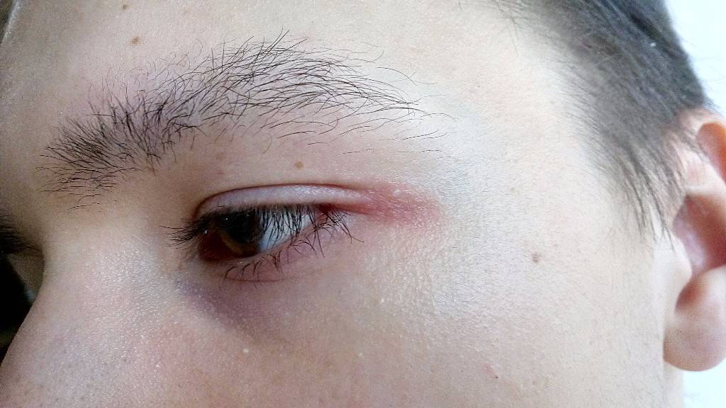 Болит уголок глаза внешний или внутренний