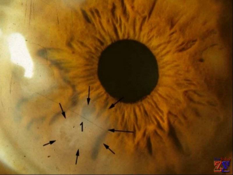 Эрозия роговицы глаза: как лечить - "здоровое око"