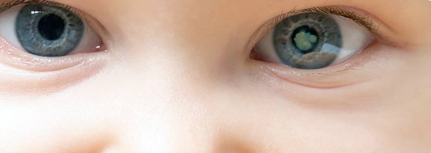 Врожденная катаракта - признаки, симптомы, лечение. офтальмологический портал vseozrenii.