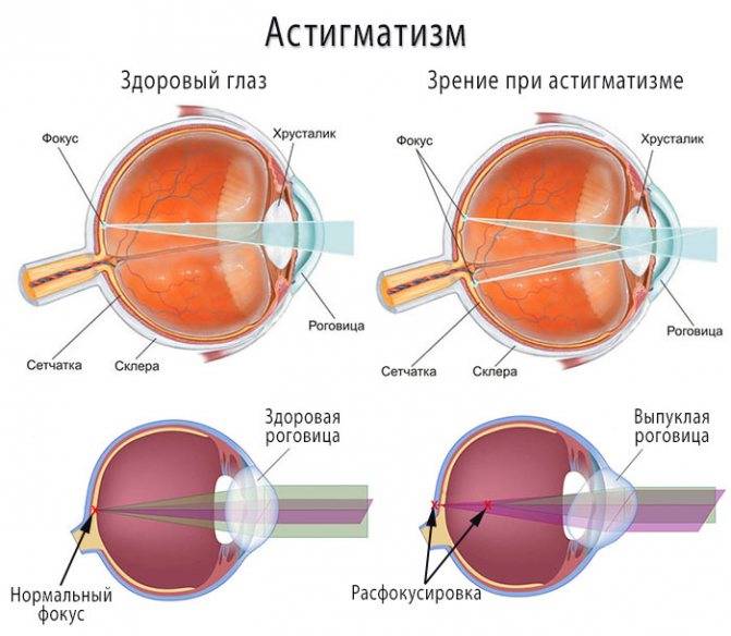 Врожденный астигматизм — причины, лечение и степени заболевания — глаза эксперт