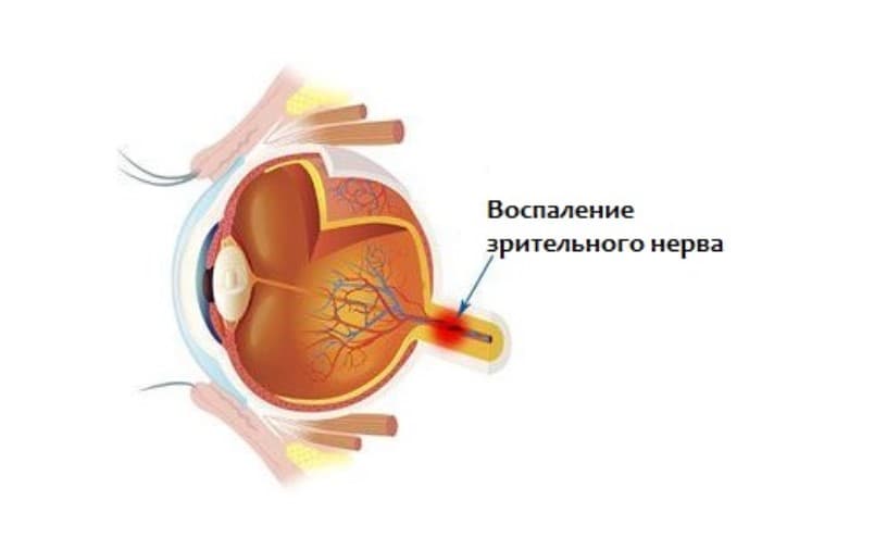 Неврит зрительного нерва: симптомы и лечение, ишемический