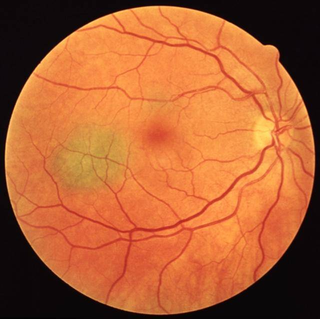 Невус хориоидеи глаза: симптомы, причины, лечение, что это такое и каков прогноз, виды (пигментный, прогрессирующий, атипичный), удаление