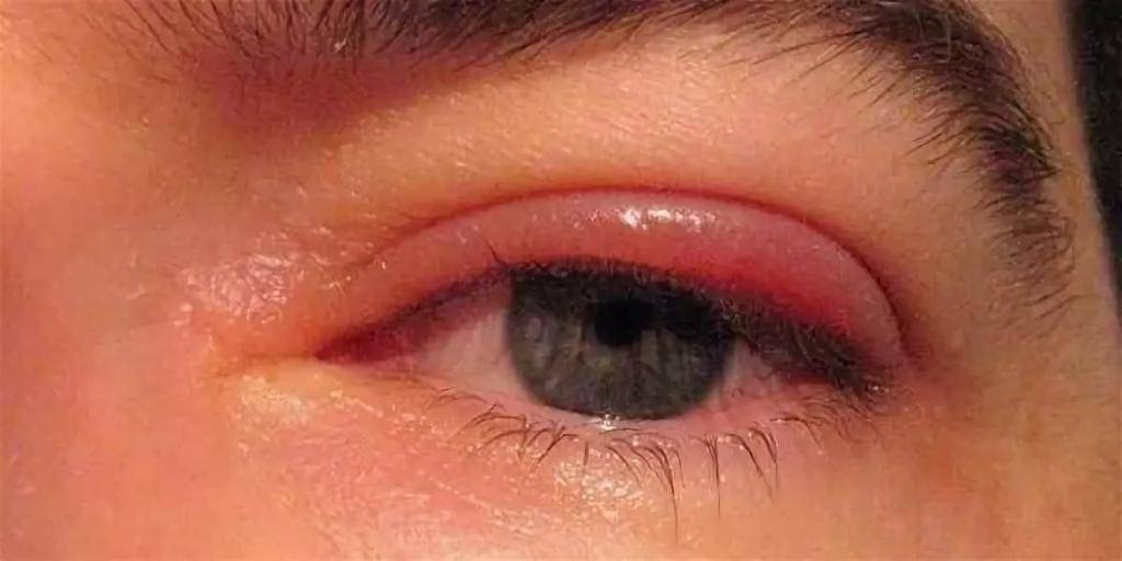 Герпес на глазу: фото на глазах, симптомы на веке, под глазом, простуда глаза