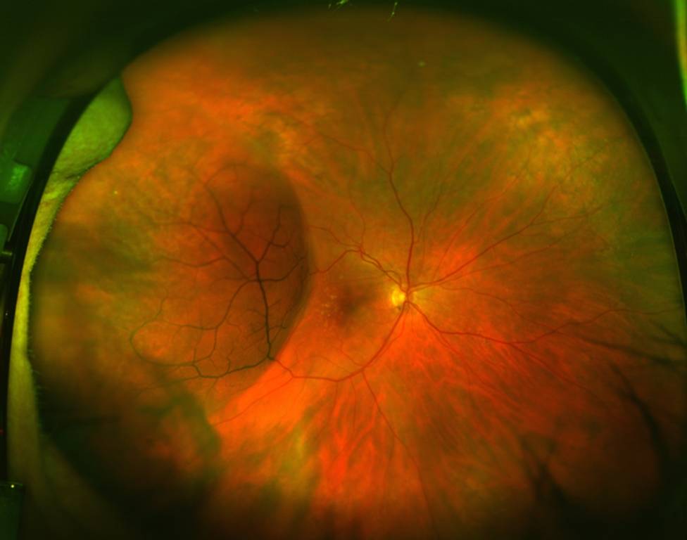 Ретиношизис сетчатки глаза: что это такое, симптомы, лечение, прогноз