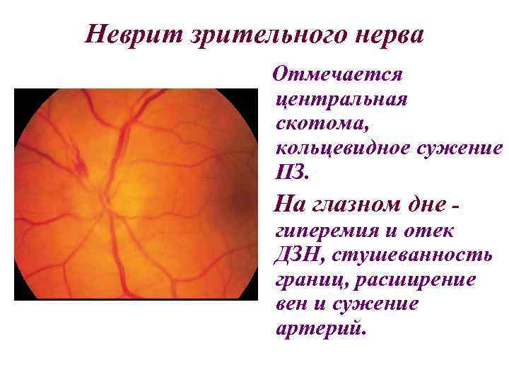 Неврит зрительного нерва: слепота или проходящий процесс
