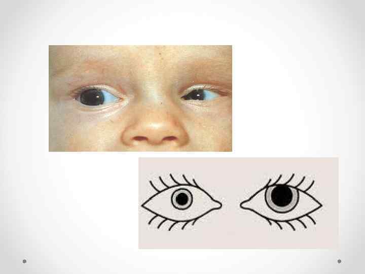 Лечение анизометропии у детей | мнтк «микрохирургия глаза» им. акад. с.н. федорова