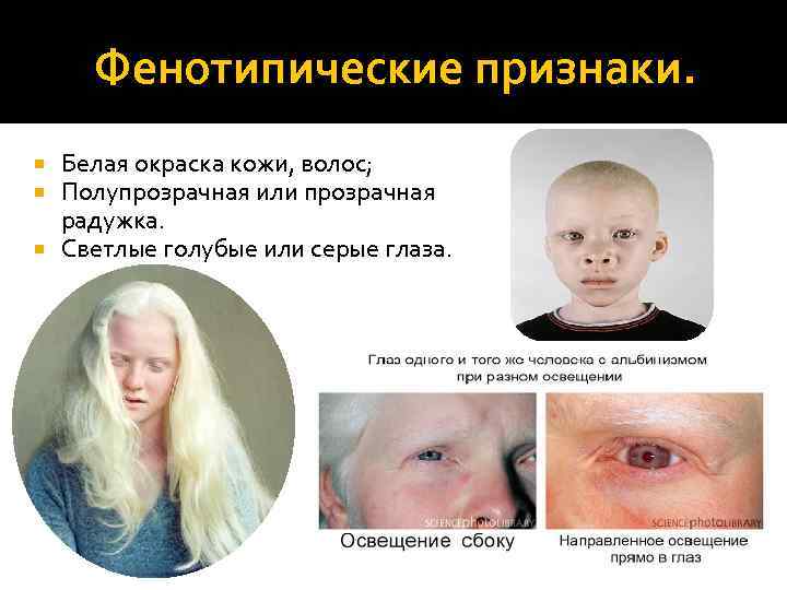 Альбинизм глаз: что это?