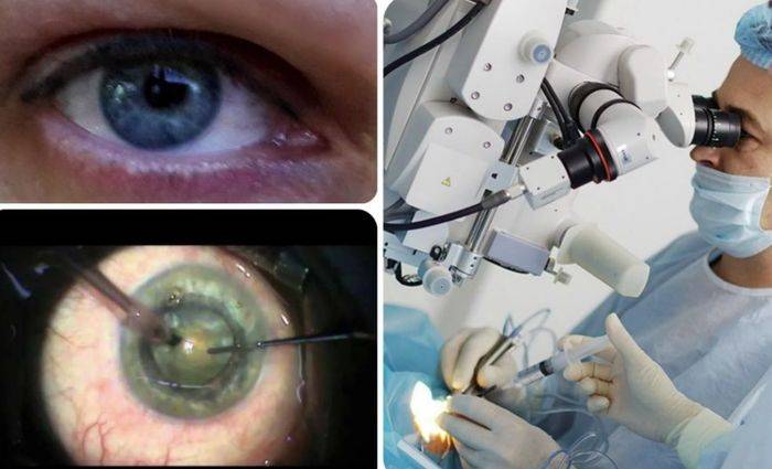 Эффективно ли лечение глаукомы лазером?