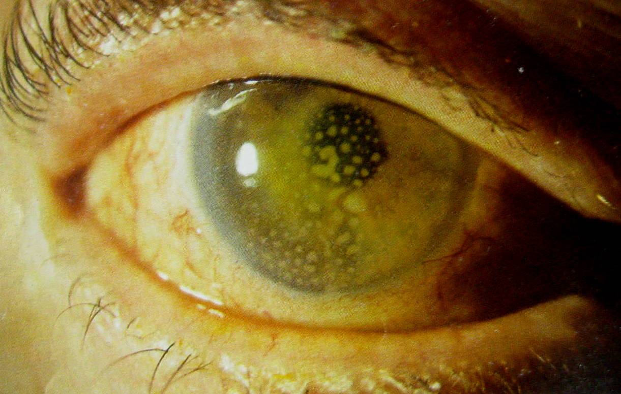 Эндофтальмит глаза симптомы причины и лечение