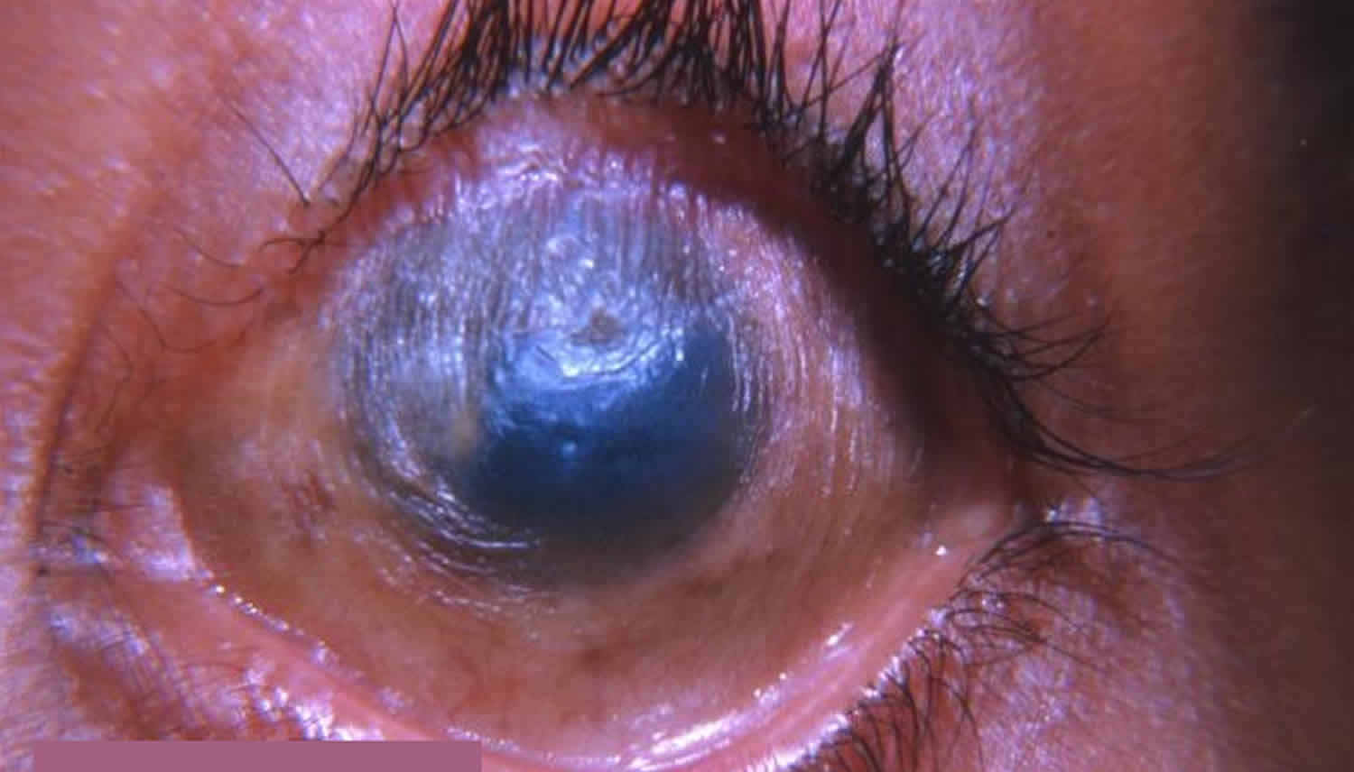 Эрозия роговицы глаза: причины, симптомы, лечение, случаи в жизни