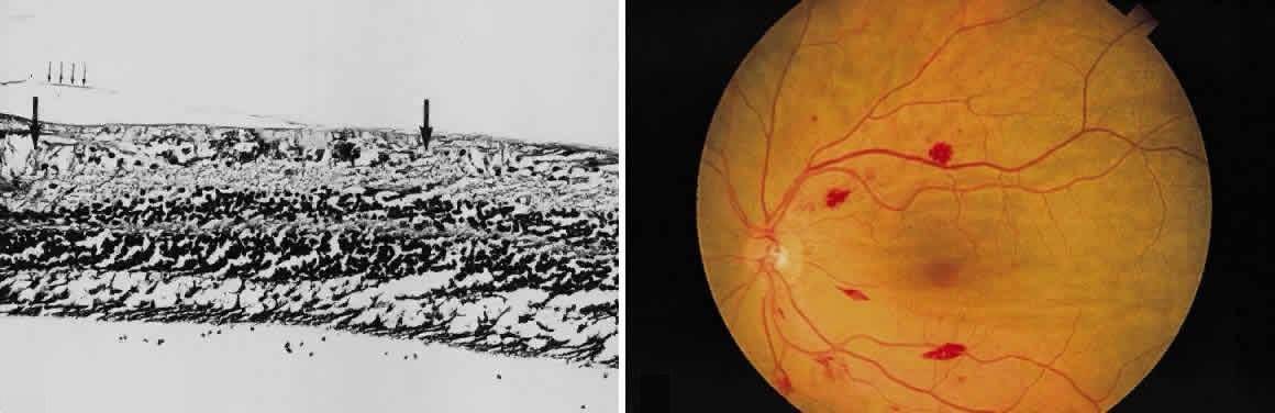 Как лечить ангиопатию (атеросклероз) сосудов сетчатки обоих глаз у взрослых и ее симптомы