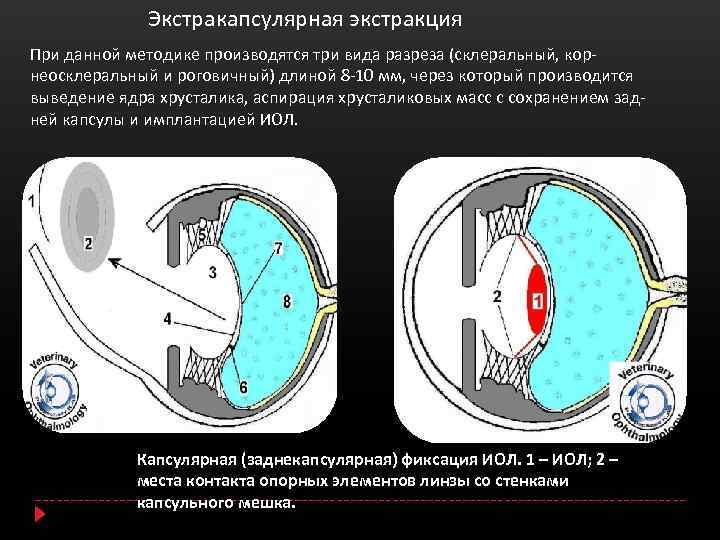 Интракапсулярная экстракция катаракты (иэк) - операция по замене хрусталика при катаракте - moscoweyes.ru - сайт офтальмологического центра "мгк-диагностик"