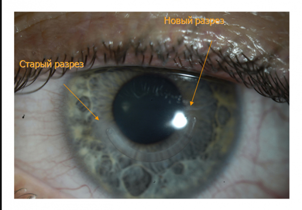 Заболевания роговицы глаза: фото, описание болезней