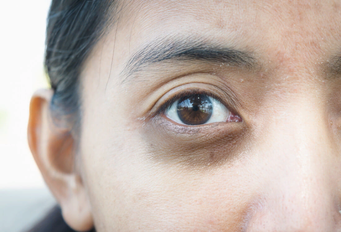Причины появления темных кругов под глазами у ребенка: генетика, физиология, заболевания | qulady