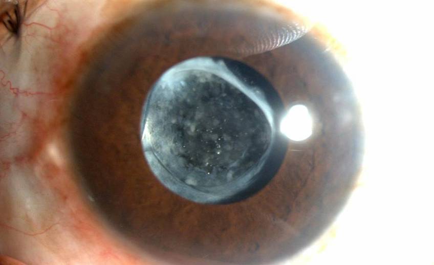 Реабилитация после замены хрусталика при катаракте: послеоперационный период