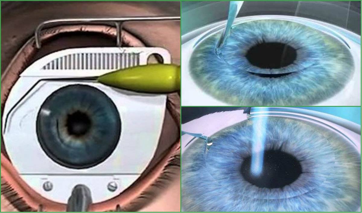 Противопоказания к лазерной коррекции зрения: когда нельзя делать операцию при близорукости