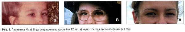 С какого возраста можно делать операцию на глаза косоглазие tdfarm