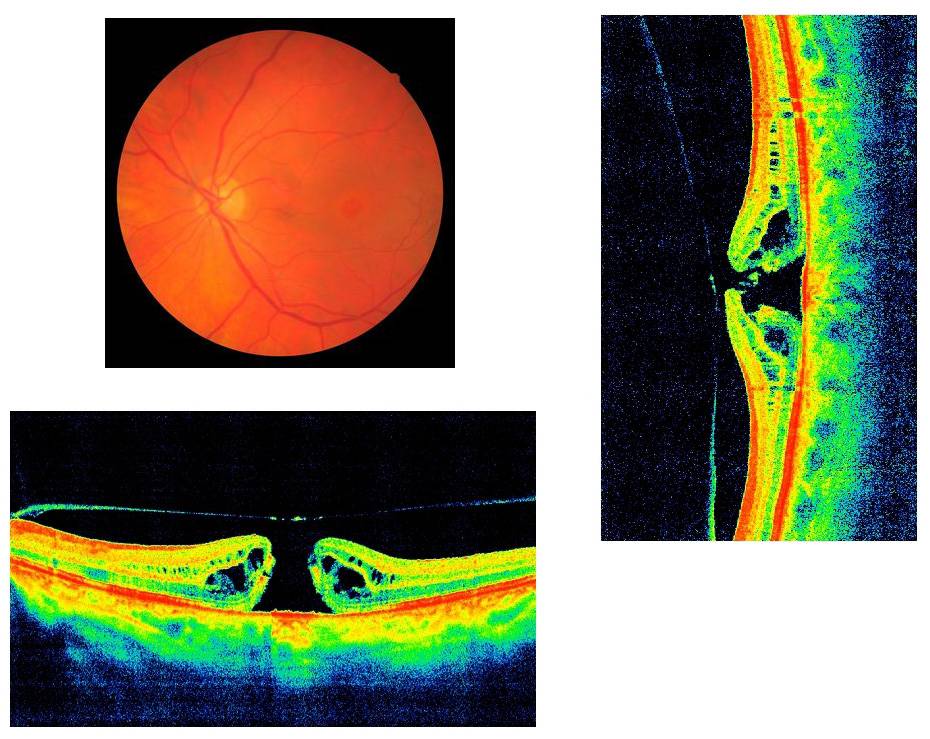 Атрофия зрительного нерва: что это такое - частичная обоих глаз, лечение и как лечить у детей, причины атрофирования у взрослых, чазн
