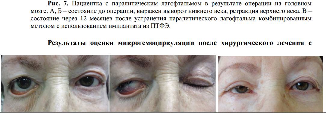 Лагофтальм глаза: лечение, причины, симптомы, осложнения и профилактика