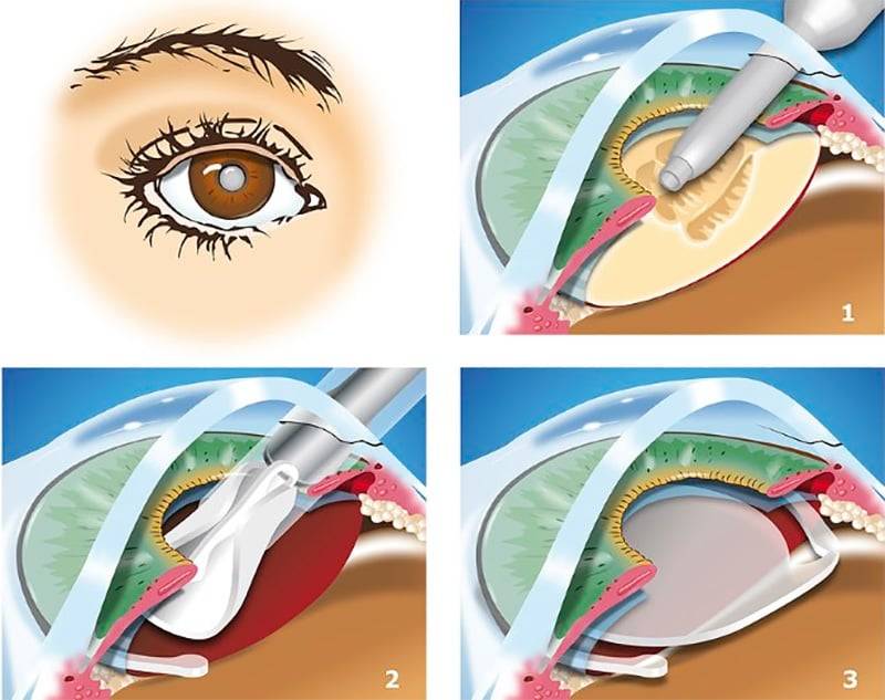Всё самое важное об операции по замене хрусталика глаза