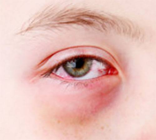 Красные глаза у ребенка: при аллергии (чешутся), при простуде с соплями и насморком - что делать при проявлении симптомов