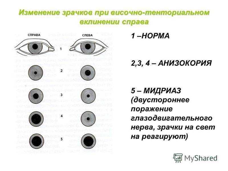 Почему зрачки бывают разного размера: возможные причины oculistic.ru
почему зрачки бывают разного размера: возможные причины
