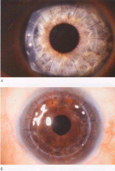 Кератопластика: как проходит операция - "здоровое око"