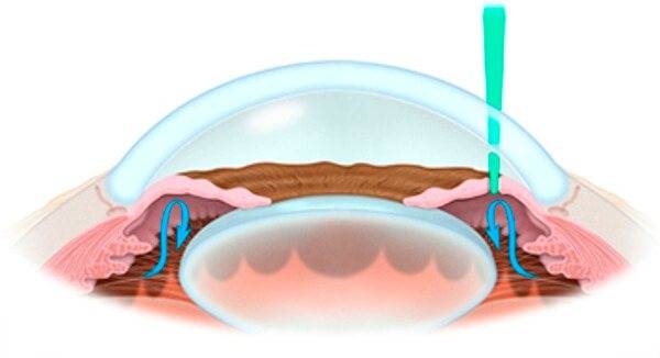 Лазерная иридэктомия (иридотомия) лиэ при глаукоме - цены и отзывы об операции