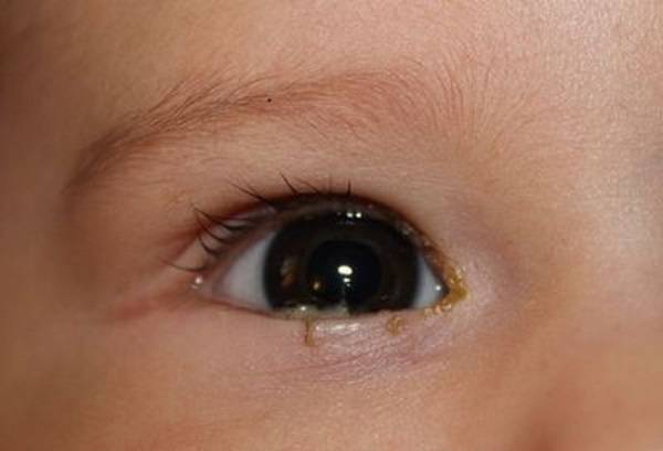 Почему гноятся глаза у ребенка