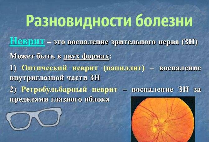 Ретробульбарный неврит зрительного нерва - симптомы и лечение