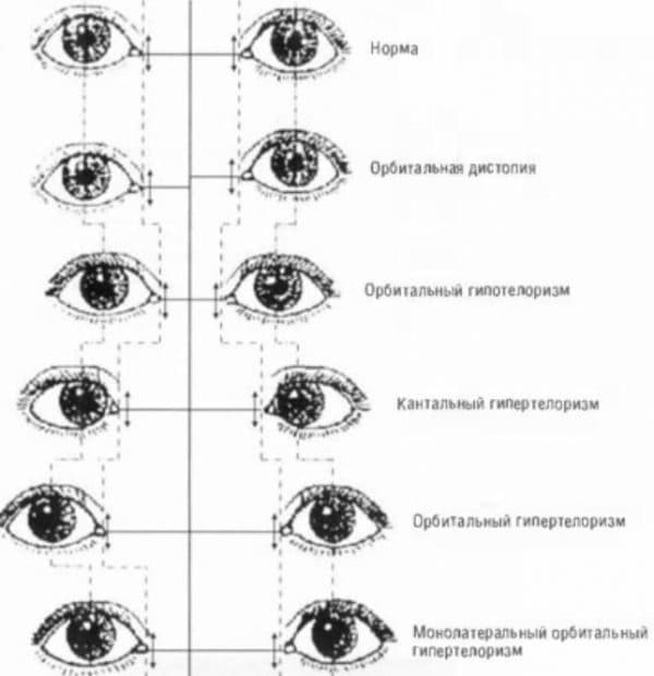 Расстояние между центрами глаз. Орбитальный гипертелоризм. Нормальное расположение глаз у ребенка. Расстояние между центрами зрачков глаз норма. У ребёнка широко расположены глаза.