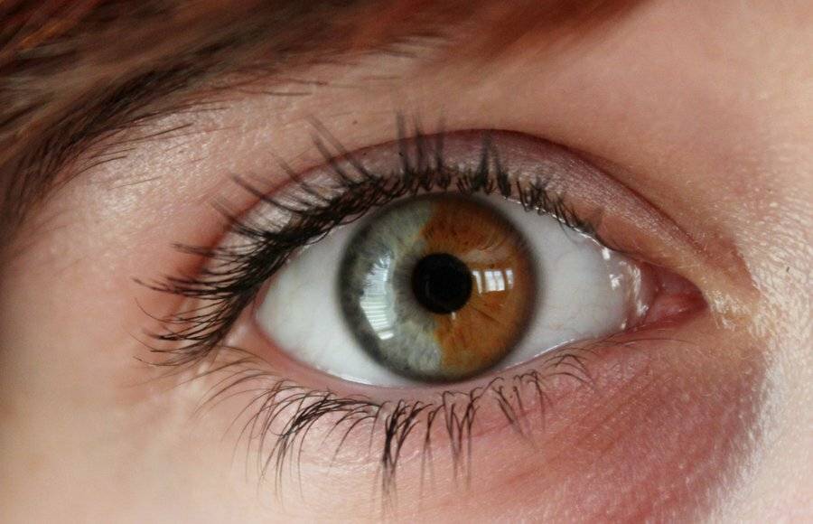 Гетерохромия глаз у людей - что это, причины появления и лечение