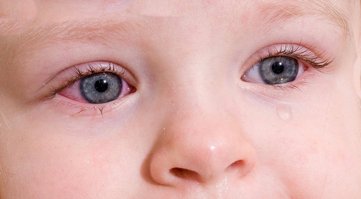 ?конъюнктивит глаз: лечение у детей ?мазями, ?каплями и ?народными средствами – профилактика