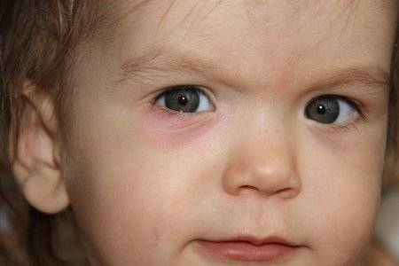 Красные круги под глазами у ребенка: причины появления и методы избавления от проблемы